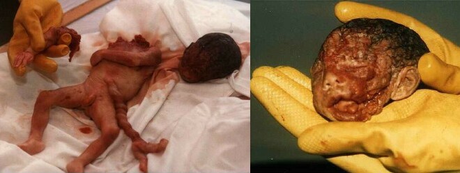 abortion 8 weeks. Right: Twenty weeks aborted